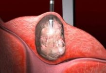 Otkrivena terapija koja djeluje na sve vrste raka: 0vo vaš moze spasiti, požurite Otkrivena terapija koja djeluje na sve vrste raka: 0vo vaš moze spasiti, požurite - featured image