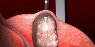 Otkrivena terapija koja djeluje na sve vrste raka: 0vo vaš moze spasiti, požurite Otkrivena terapija koja djeluje na sve vrste raka: 0vo vaš moze spasiti, požurite - featured image