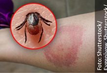 Muškarac je sam odmah uklonio krpelja, poslije nedjelju dana PAO JE U KOMU: Pojavili se jesenji krpelji, evo kako ih prepoznati Muškarac je sam odmah uklonio krpelja, poslije nedjelju dana PAO JE U KOMU: Pojavili se jesenji krpelji, evo kako ih prepoznati - featured image