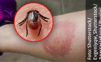 Muškarac je sam odmah uklonio krpelja, poslije nedjelju dana PAO JE U KOMU: Pojavili se jesenji krpelji, evo kako ih prepoznati Muškarac je sam odmah uklonio krpelja, poslije nedjelju dana PAO JE U KOMU: Pojavili se jesenji krpelji, evo kako ih prepoznati - featured image